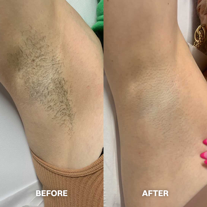 kklonw® Body Hair Removal Cream for All Women & Men