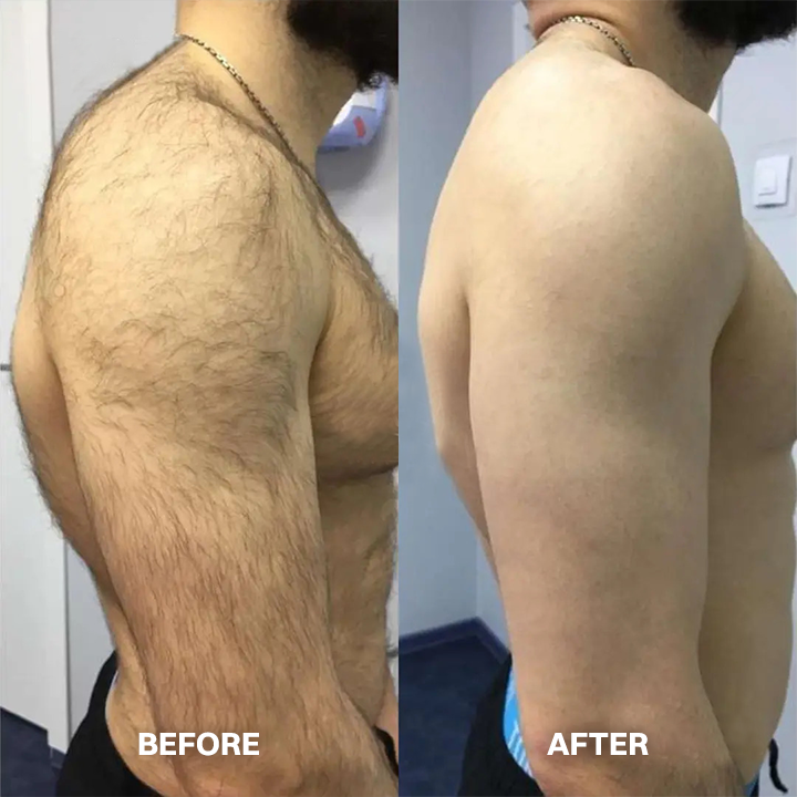 kklonw® Body Hair Removal Cream for All Women & Men