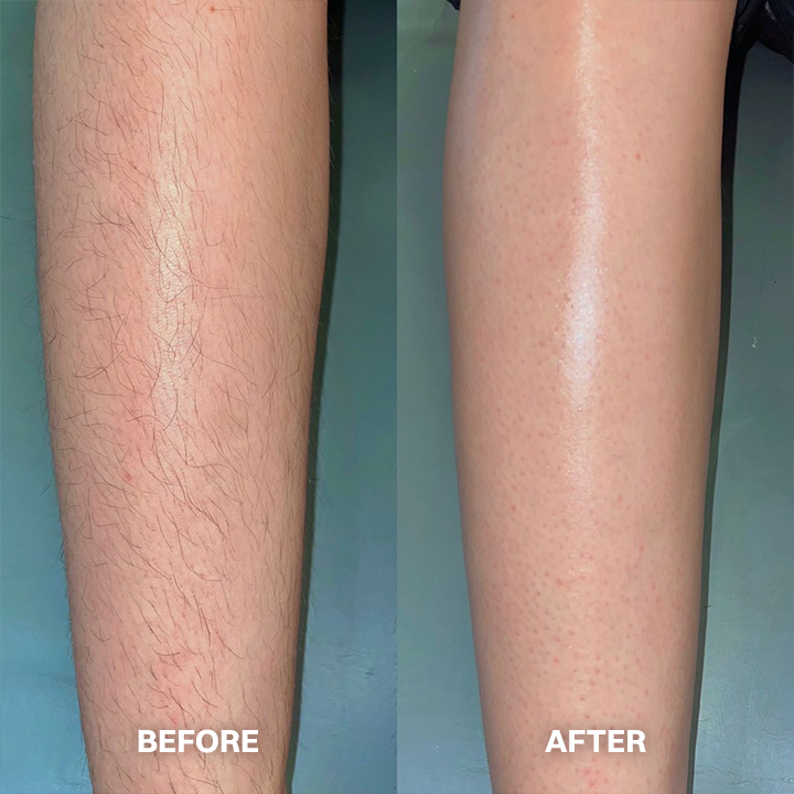 kklonw® Body Hair Removal Cream for All Women & Men