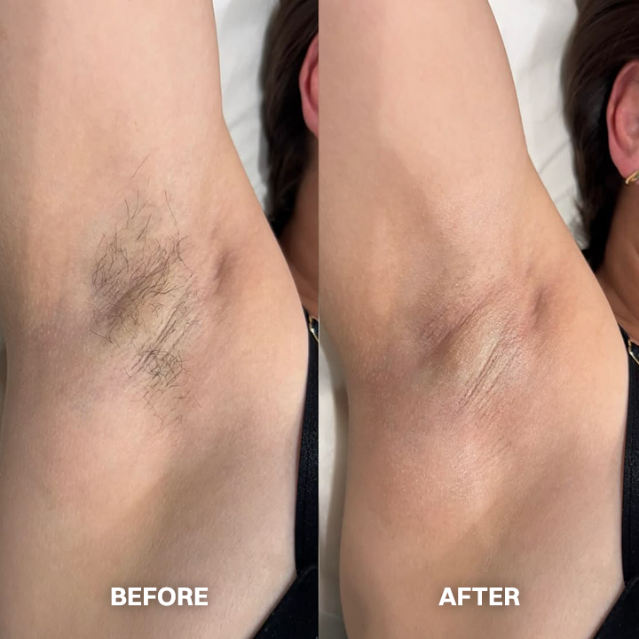 kklonw® Body Hair Removal Cream for All Women & Men